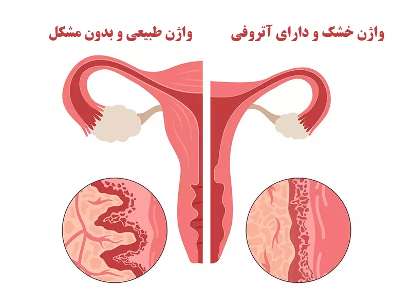 تفاوت خشکی واژن با واژن طبیعی