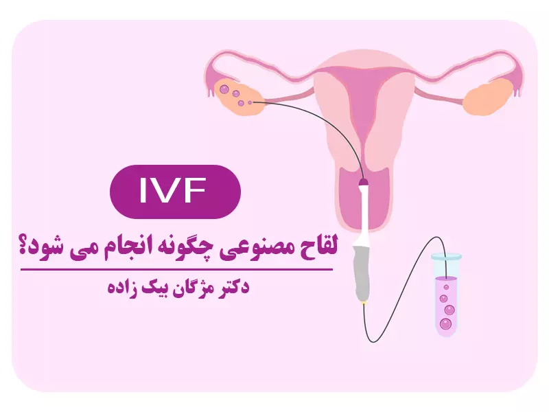 IVF یا لقاح مصنوعی چیست