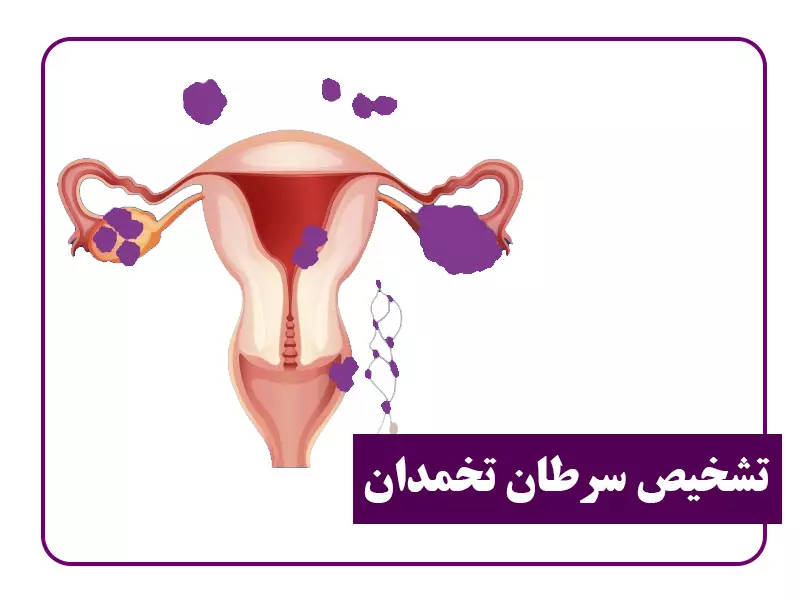 تشخیص سرطان تخمدان
