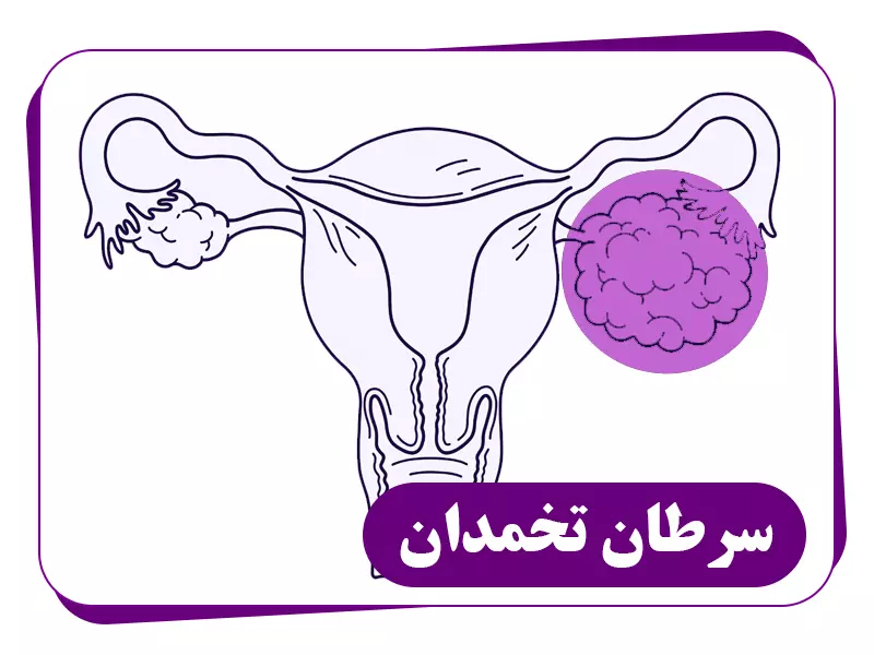 سرطان تخمدان چیست؟