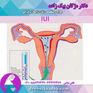 IUI