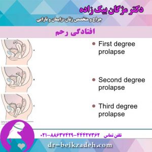 افتادگی رحم