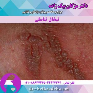 تبخال