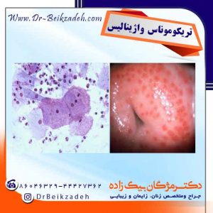 تریکوموناس واژینالیس
