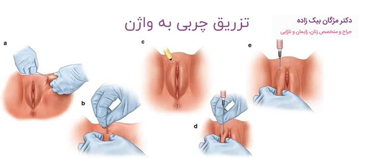 تزریق چربی به واژن