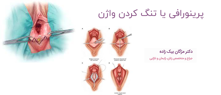 تنگ کردن واژن