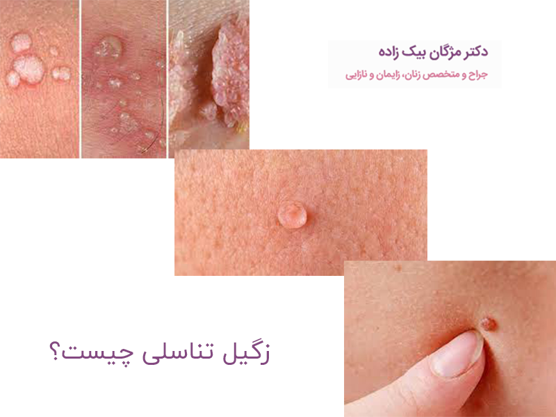 درباره زگیل تناسلی
