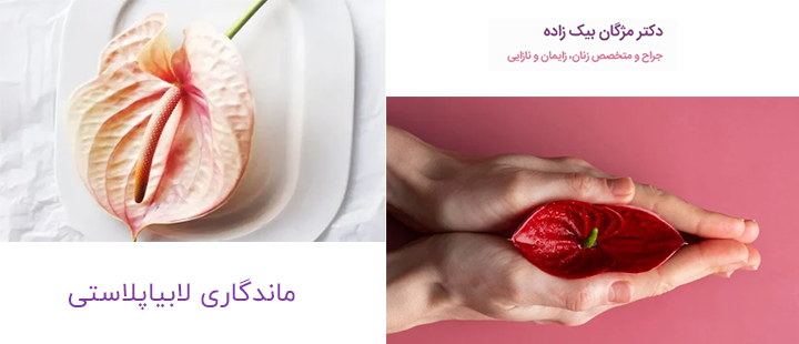 درباره ماندگاری لابیاپلاستی