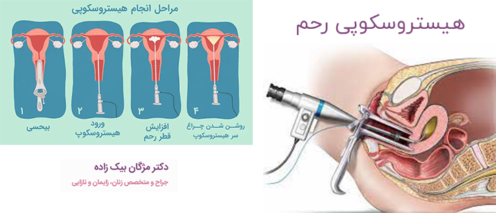 هیستروسکوپی رحم