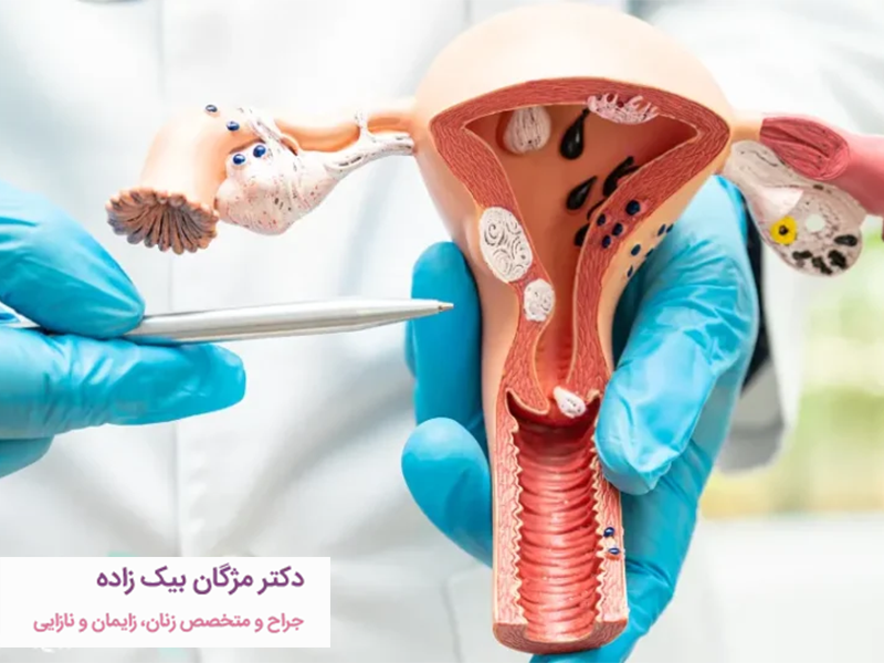 درمان فیبروم رحم چیست؟