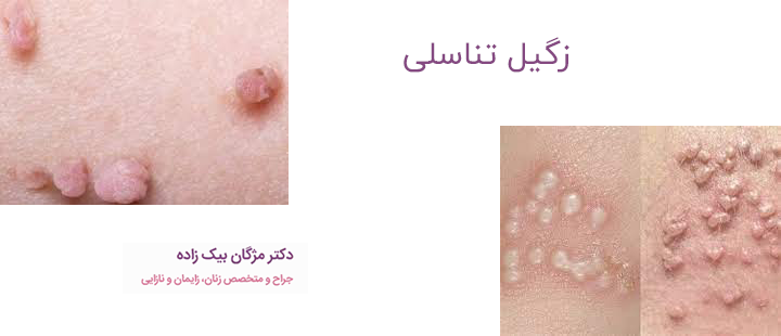 زگیل تناسلی