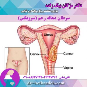 سرطان-دهانه-رحم