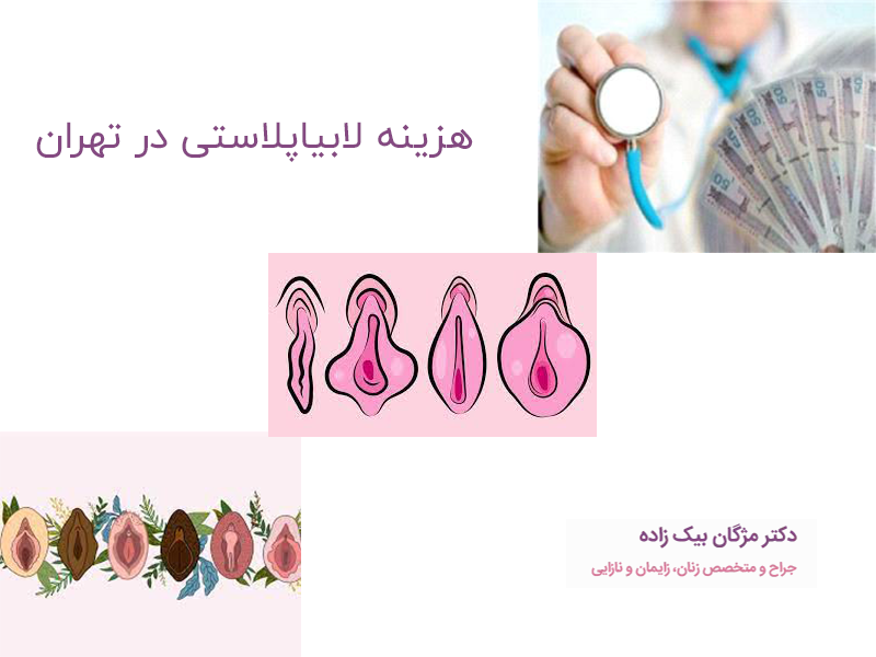 میزان هزینه لابیاپلاستی در تهران