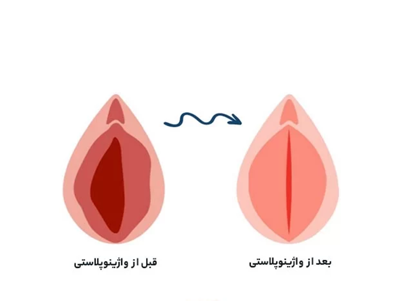 واژینوپلاستی