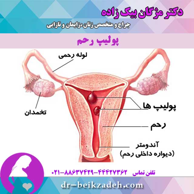 پولیپ رحم