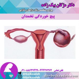 پیچ خوردگی تخمدان