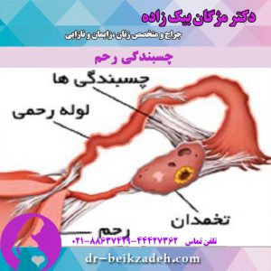 چسبندگی رحم