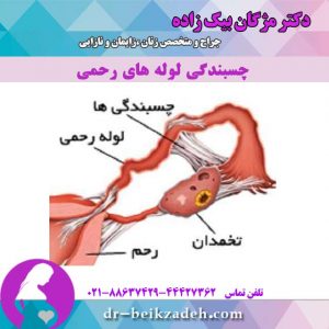 چسبندگی لوله های رحمی