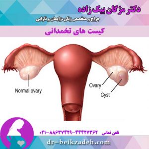 کیست-های-تخمدانی